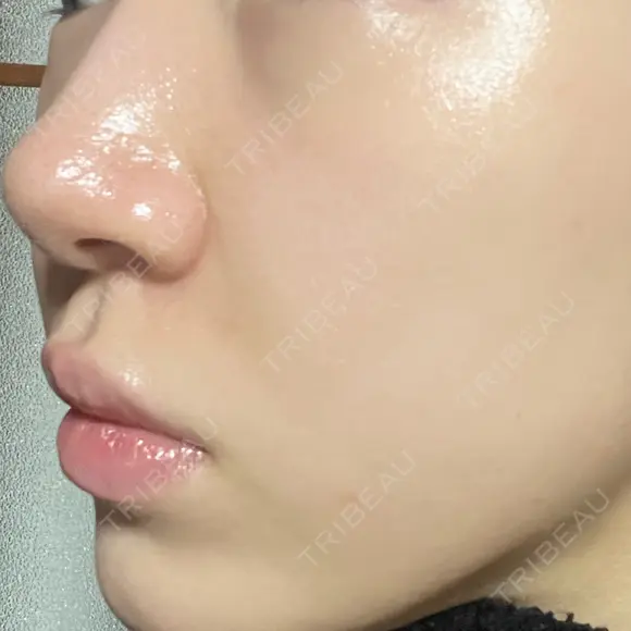 ボトックス（口角） / ヒアルロン酸注入（鼻翼基部） ルラ美容クリニック 大阪本院 DAY 2 メイン用