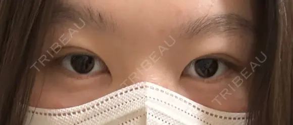 二重埋没 湘南美容クリニック 千葉センシティ院 DAY 2 メイン用