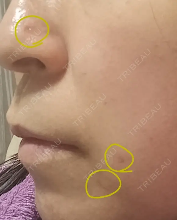 ほくろ・いぼ切除（肌） CLINIC W DAY 21 メイン用