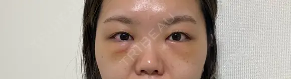 クマ治療 湘南美容クリニック 千葉センシティ院 DAY 3 メイン用