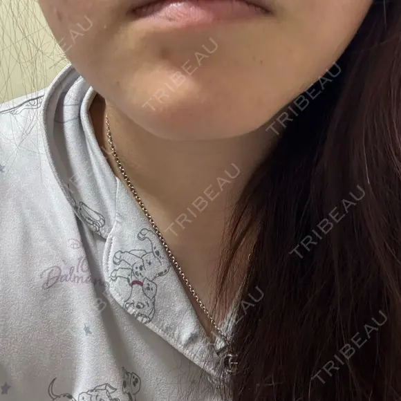 脂肪溶解注射（顔） ルラ美容クリニック 横浜院 AFTER メイン用