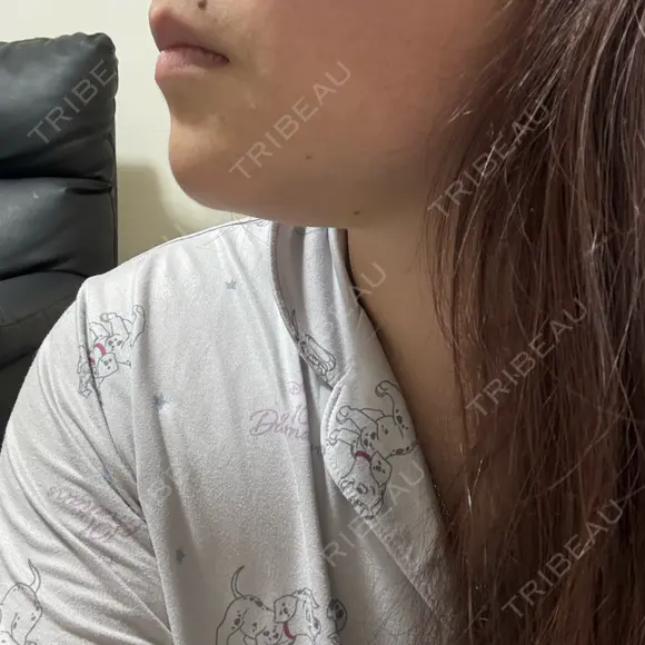 脂肪溶解注射（顔） ルラ美容クリニック 横浜院 DAY 6 メイン用