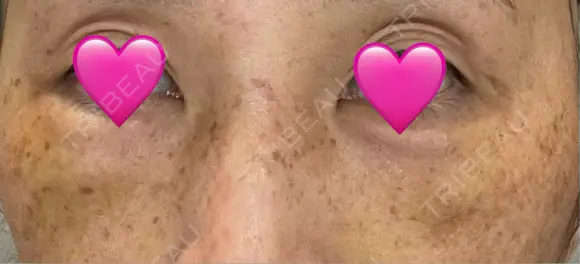 クマ治療 湘南美容クリニック 千葉センシティ院 DAY 4 メイン用