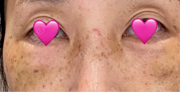 クマ治療 湘南美容クリニック 千葉センシティ院 DAY 3 メイン用