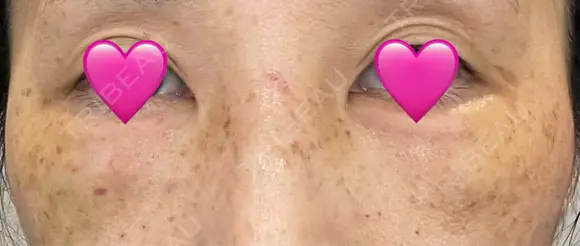 クマ治療 湘南美容クリニック 千葉センシティ院 DAY 2 メイン用