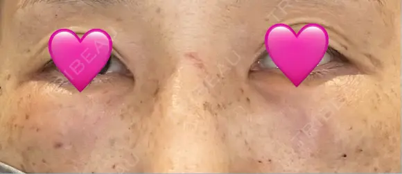 クマ治療 湘南美容クリニック 千葉センシティ院 DAY 1 メイン用