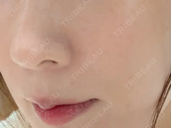 真皮移植 / 鼻翼基部形成（貴族手術） EMMO FACE CLINIC 東京三田院 DAY 9 メイン用