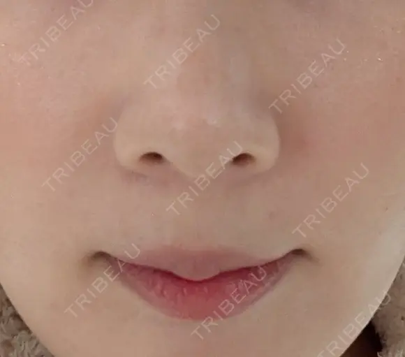 真皮移植 / 鼻翼基部形成（貴族手術） EMMO FACE CLINIC 東京三田院 DAY 9 メイン用