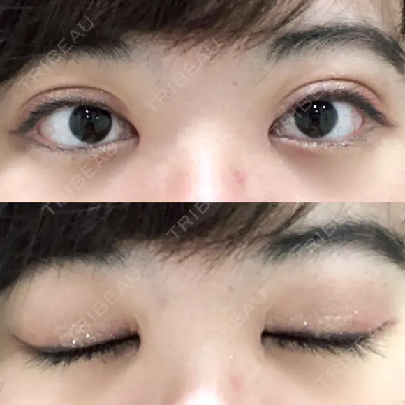 二重切開 / 目頭切開 / ほくろ・いぼ切除（肌） / 上まぶたたるみ取り / 上まぶたの脂肪取り 東京美容外科 銀座院 DAY 54 メイン用