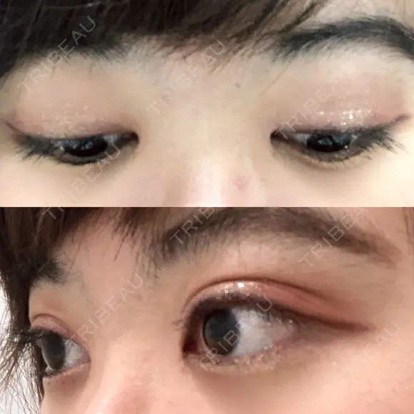 二重切開 / 目頭切開 / ほくろ・いぼ切除（肌） / 上まぶたたるみ取り / 上まぶたの脂肪取り 東京美容外科 銀座院 DAY 54 メイン用