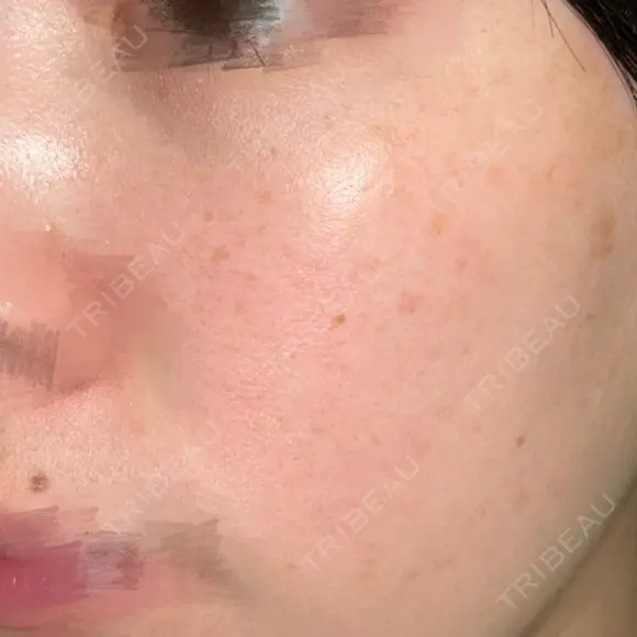 ピーリング（ニキビ・毛穴） / 光治療（フォトフェイシャルなど） ルラ美容クリニック 横浜院 DAY 1 メイン用