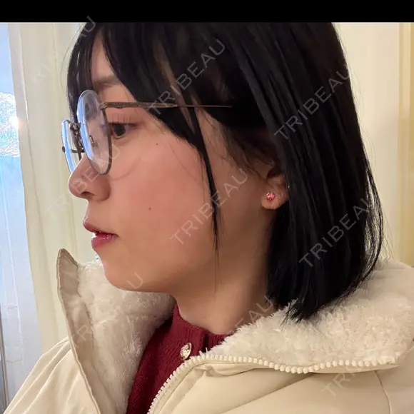 糸リフト / 脂肪吸引（顔） 新宿美容外科ネビュラクリニック AFTER メイン用