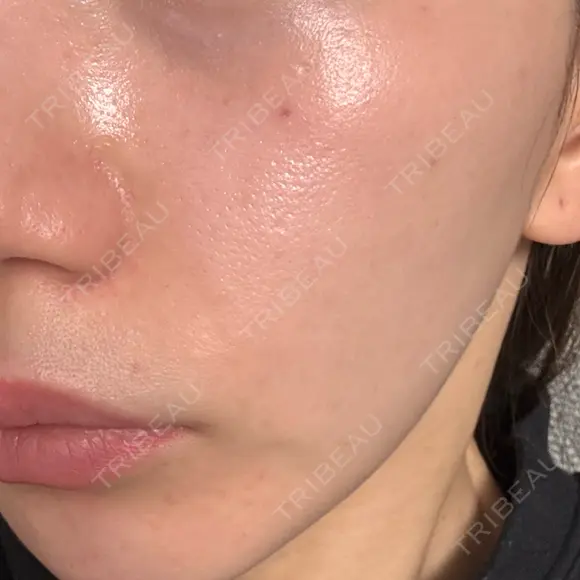 水光注射（ハリ・美肌） CHARIS BEAUTY CLINIC AFTER メイン用