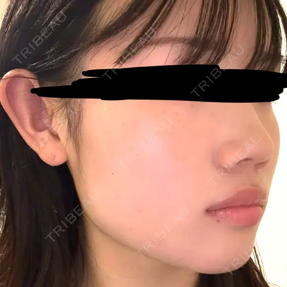 ボトックス（エラ・小顔） DMTC CLINIC 日本橋院 DAY 0 メイン用