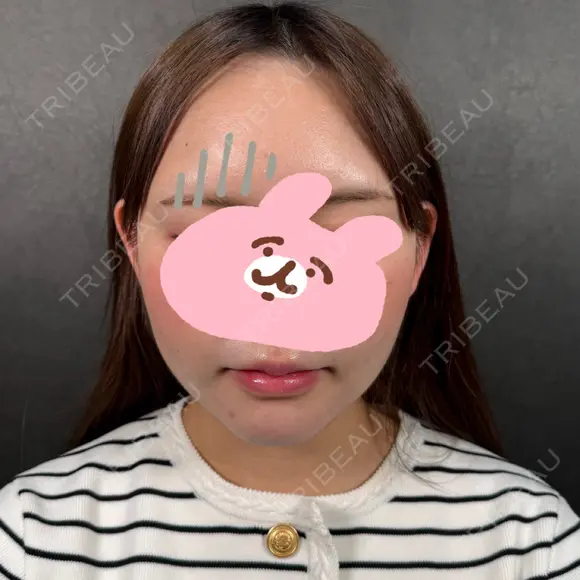 糸リフト / 脂肪吸引（顔） / ジョールファット除去 新宿美容外科ネビュラクリニック AFTER メイン用