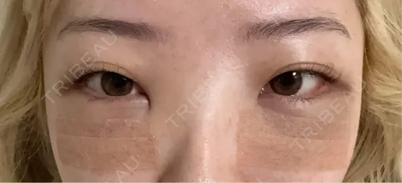 クマ治療 / 下まぶたたるみ取り / 下まぶたの脂肪取り / ヒアルロン酸注入（目の下） / スネコス 新宿美容外科ネビュラクリニック DAY 1 メイン用