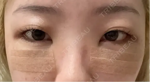 クマ治療 / 下まぶたたるみ取り / 下まぶたの脂肪取り / ヒアルロン酸注入（目の下） / スネコス 新宿美容外科ネビュラクリニック DAY 2 メイン用