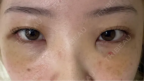 クマ治療 / 下まぶたたるみ取り / 下まぶたの脂肪取り / ヒアルロン酸注入（目の下） / スネコス 新宿美容外科ネビュラクリニック DAY 3 メイン用