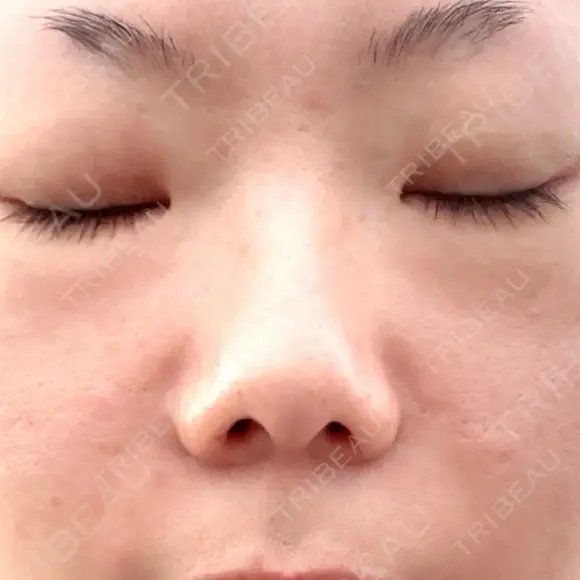 肌ヒアルロン酸注入（たるみ・シワ改善） 博多美容外科/美容皮膚科 ビラビューティークリニック DAY 0 メイン用