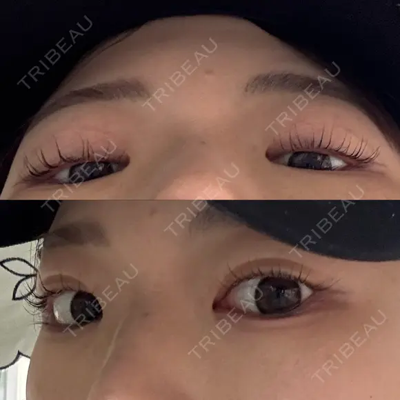ヒアルロン酸注入（涙袋） PRO CLINIC プロクリニック 銀座院 DAY 6 メイン用