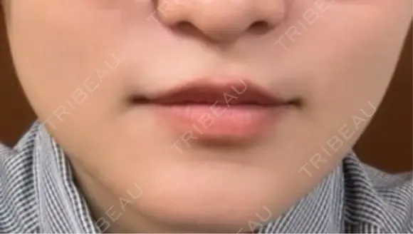 肌ヒアルロン酸注入（たるみ・シワ改善） / ボトックス（エラ・小顔） 東京シンデレラ美容外科 新宿院 DAY 0 メイン用