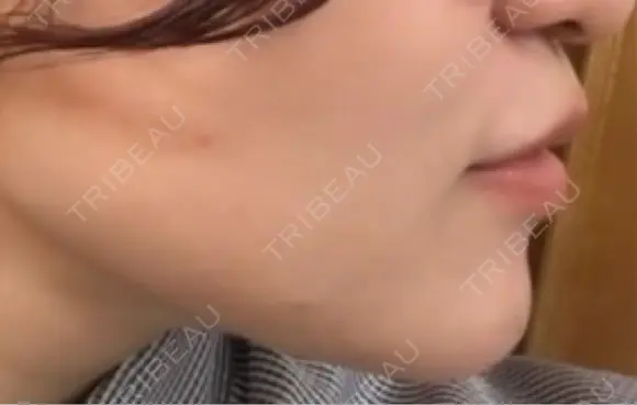 肌ヒアルロン酸注入（たるみ・シワ改善） / ボトックス（エラ・小顔） 東京シンデレラ美容外科 新宿院 DAY 0 メイン用