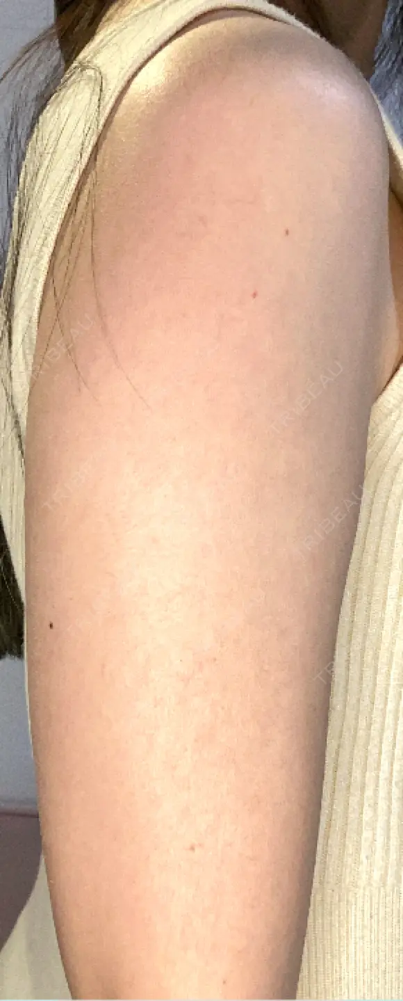 その他（輪郭） 美容皮膚科エルムクリニック 大阪院 DAY 20 メイン用