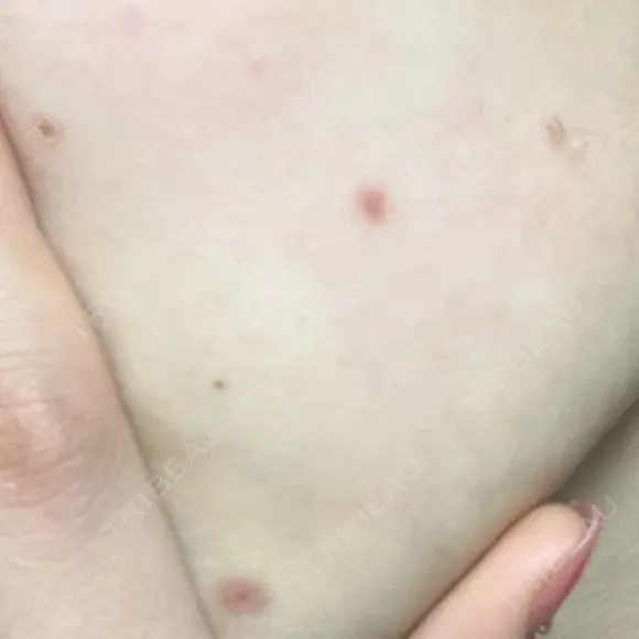 ほくろ・いぼ切除（肌） フローラクリニック DAY 10 メイン用