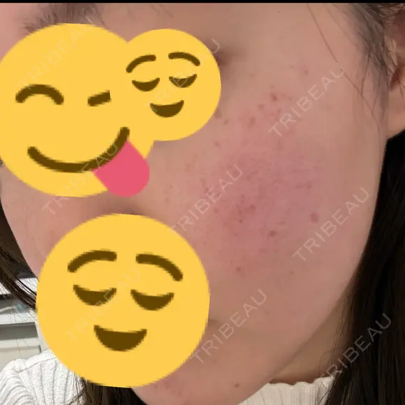 光治療（フォトフェイシャルなど） / ルメッカ 眠れるスキンクリニック田町 DAY 0 メイン用