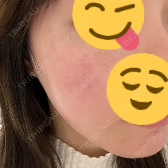 光治療（フォトフェイシャルなど） / ルメッカ 眠れるスキンクリニック田町 DAY 0 メイン用