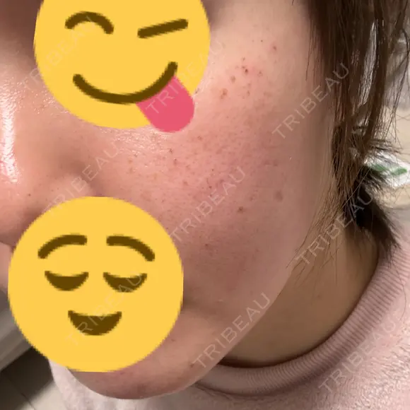 光治療（フォトフェイシャルなど） / ルメッカ 眠れるスキンクリニック田町 AFTER メイン用