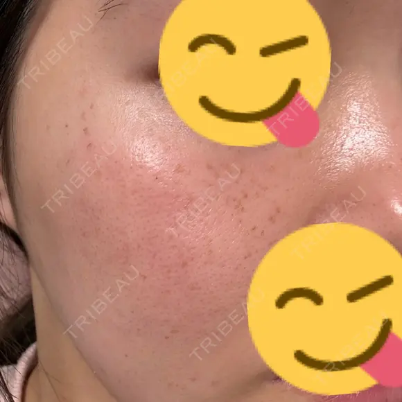 光治療（フォトフェイシャルなど） / ルメッカ 眠れるスキンクリニック田町 DAY 1 メイン用