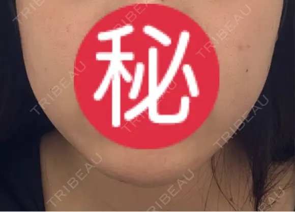 オンダリフト LIGHT CLINIC 【ライトクリニック】 名古屋院 AFTER メイン用