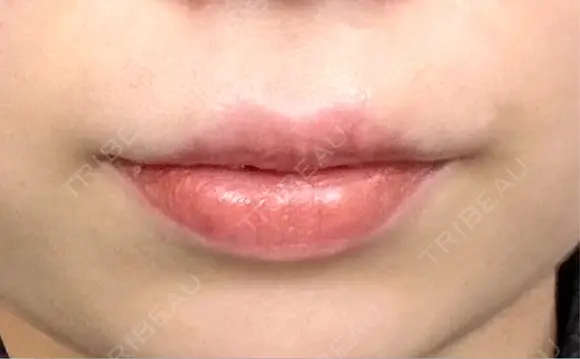 口唇縮小術 博多美容外科/美容皮膚科 ビラビューティークリニック DAY 34 メイン用