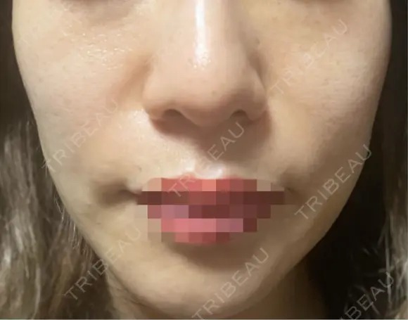 ピコレーザートーニング（美白・肝斑） 博多美容外科/美容皮膚科 ビラビューティークリニック AFTER メイン用