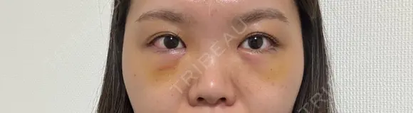 クマ治療 湘南美容クリニック 千葉センシティ院 DAY 4 メイン用