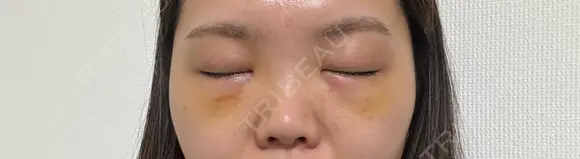 クマ治療 湘南美容クリニック 千葉センシティ院 DAY 4 メイン用