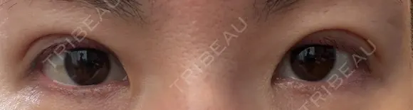 二重埋没 湘南美容クリニック 千葉センシティ院 AFTER メイン用