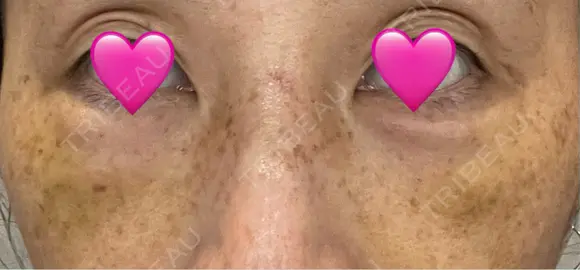 クマ治療 湘南美容クリニック 千葉センシティ院 DAY 6 メイン用