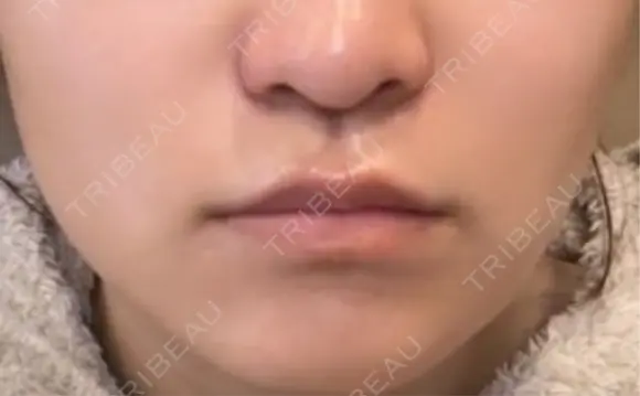 肌ヒアルロン酸注入（たるみ・シワ改善） / ボトックス（エラ・小顔） 東京シンデレラ美容外科 新宿院 DAY 1 メイン用