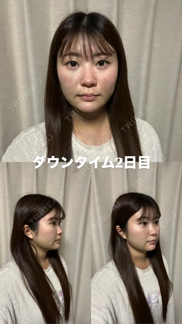 糸リフト / 脂肪吸引（顔） / ジョールファット除去 / ヒアルロン酸注入（あご） / ボトックス（エラ・小顔） 新宿美容外科ネビュラクリニック DAY 2 メイン用