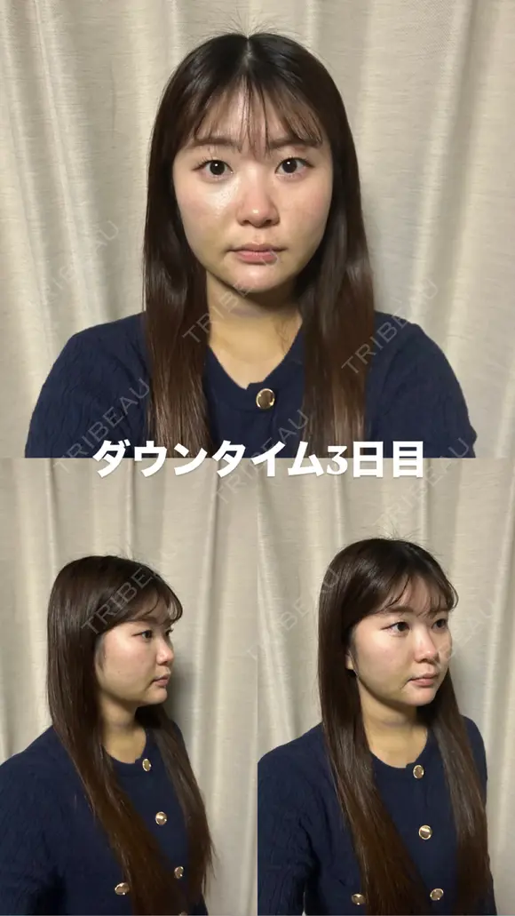 糸リフト / 脂肪吸引（顔） / ジョールファット除去 / ヒアルロン酸注入（あご） / ボトックス（エラ・小顔） 新宿美容外科ネビュラクリニック DAY 3 メイン用