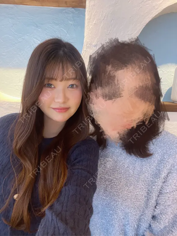 糸リフト / 脂肪吸引（顔） / ジョールファット除去 / ヒアルロン酸注入（あご） / ボトックス（エラ・小顔） 新宿美容外科ネビュラクリニック DAY 7 メイン用