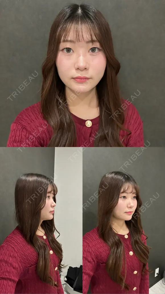 糸リフト / 脂肪吸引（顔） / ジョールファット除去 / ヒアルロン酸注入（あご） / ボトックス（エラ・小顔） 新宿美容外科ネビュラクリニック DAY 12 メイン用