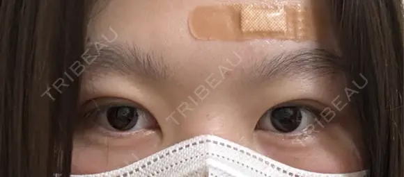 二重埋没 湘南美容クリニック 千葉センシティ院 DAY 3 メイン用