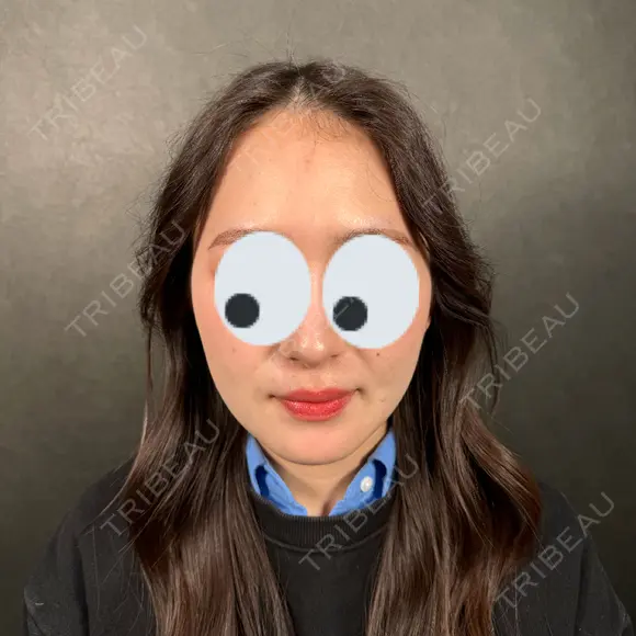 糸リフト / 脂肪吸引（顔） / ジョールファット除去 新宿美容外科ネビュラクリニック AFTER メイン用