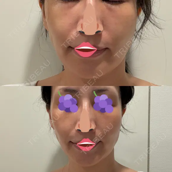 オリジオ PRISM Beauty Clinic 新宿院 DAY 0 メイン用