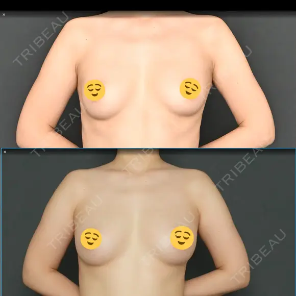 脂肪吸引（脚） / 豊胸（脂肪注入） Lipo Clinic omotesando AFTER メイン用
