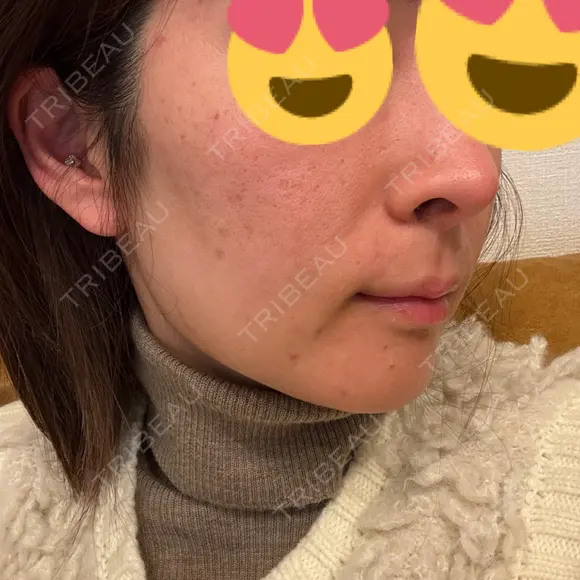 ボトックス（エラ・小顔） / ボトックス（口角） DMTC美容皮膚科 大宮院 DAY 15 メイン用