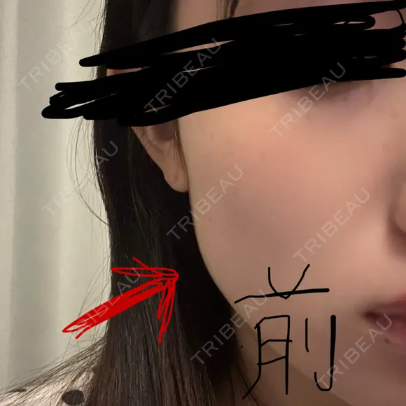 ボトックス（エラ・小顔） DMTC CLINIC 日本橋院 DAY 1 メイン用